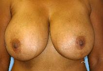 Breast Reduction Before Photo by Scott Holley, MD; Portage, MI - Case 7765