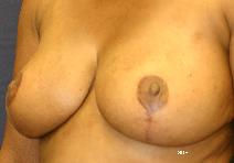 Breast Reduction After Photo by Scott Holley, MD; Portage, MI - Case 7765