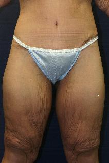 Body Contouring After Photo by Scott Holley, MD; Portage, MI - Case 7787