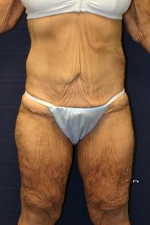 Body Contouring Before Photo by Scott Holley, MD; Portage, MI - Case 7787