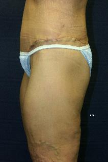 Body Contouring After Photo by Scott Holley, MD; Portage, MI - Case 7787