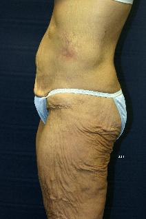 Body Contouring Before Photo by Scott Holley, MD; Portage, MI - Case 7787
