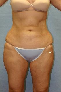 Liposuction After Photo by Scott Holley, MD; Portage, MI - Case 7790