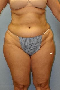 Liposuction Before Photo by Scott Holley, MD; Portage, MI - Case 7790