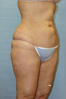 Liposuction After Photo by Scott Holley, MD; Portage, MI - Case 7790