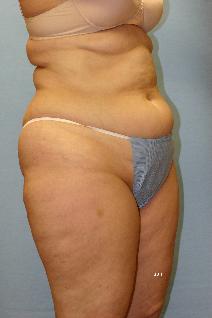 Liposuction Before Photo by Scott Holley, MD; Portage, MI - Case 7790