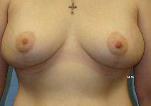Breast Lift After Photo by Scott Holley, MD; Portage, MI - Case 7795