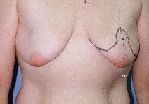 Breast Lift Before Photo by Scott Holley, MD; Portage, MI - Case 7795