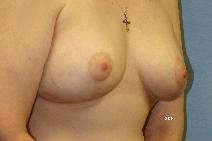 Breast Lift After Photo by Scott Holley, MD; Portage, MI - Case 7795