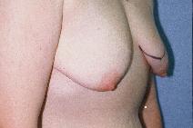 Breast Lift Before Photo by Scott Holley, MD; Portage, MI - Case 7795