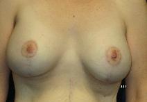 Breast Lift After Photo by Scott Holley, MD; Portage, MI - Case 7797