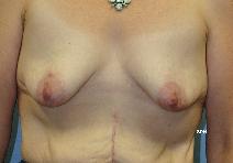 Breast Lift Before Photo by Scott Holley, MD; Portage, MI - Case 7797