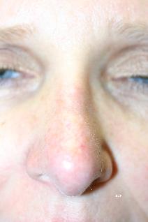 Rhinoplasty After Photo by Scott Holley, MD; Portage, MI - Case 7798
