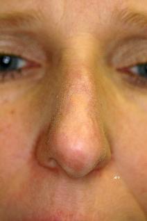 Rhinoplasty Before Photo by Scott Holley, MD; Portage, MI - Case 7798