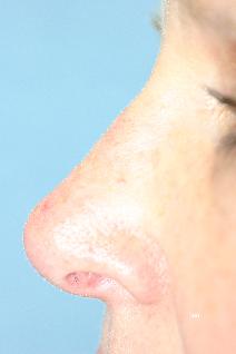 Rhinoplasty After Photo by Scott Holley, MD; Portage, MI - Case 7798