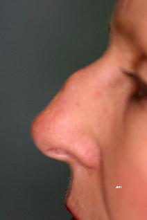 Rhinoplasty Before Photo by Scott Holley, MD; Portage, MI - Case 7798
