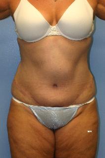 Tummy Tuck After Photo by Scott Holley, MD; Portage, MI - Case 7819