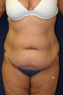 Tummy Tuck Before Photo by Scott Holley, MD; Portage, MI - Case 7819