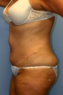 Tummy Tuck After Photo by Scott Holley, MD; Portage, MI - Case 7819