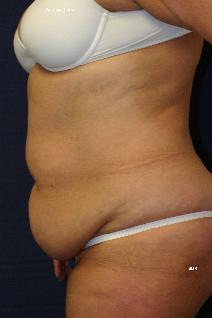 Tummy Tuck Before Photo by Scott Holley, MD; Portage, MI - Case 7819