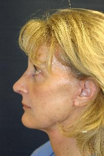 Facelift After Photo by Scott Holley, MD; Portage, MI - Case 7827