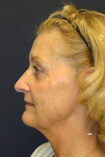 Facelift Before Photo by Scott Holley, MD; Portage, MI - Case 7827