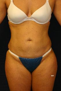 Liposuction After Photo by Scott Holley, MD; Portage, MI - Case 7829