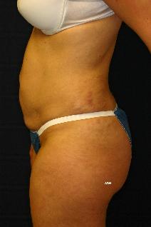 Liposuction After Photo by Scott Holley, MD; Portage, MI - Case 7829