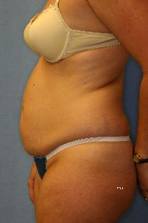 Liposuction Before Photo by Scott Holley, MD; Portage, MI - Case 7829