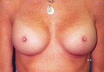 Breast Augmentation After Photo by Scott Holley, MD; Portage, MI - Case 7845