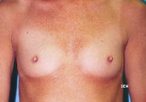 Breast Augmentation Before Photo by Scott Holley, MD; Portage, MI - Case 7845