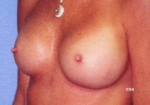 Breast Augmentation After Photo by Scott Holley, MD; Portage, MI - Case 7845