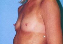 Breast Augmentation Before Photo by Scott Holley, MD; Portage, MI - Case 7845
