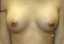 Breast Augmentation After Photo by Scott Holley, MD; Portage, MI - Case 7846