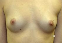 Breast Augmentation Before Photo by Scott Holley, MD; Portage, MI - Case 7846