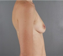 Breast Augmentation Before Photo by Patti Flint, MD; Scottsdale, AZ - Case 36352