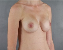 Breast Augmentation After Photo by Patti Flint, MD; Scottsdale, AZ - Case 36352