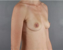 Breast Augmentation Before Photo by Patti Flint, MD; Scottsdale, AZ - Case 36352