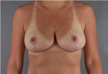 Breast Reduction After Photo by Patti Flint, MD; Scottsdale, AZ - Case 36382