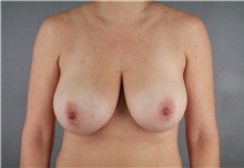 Breast Reduction Before Photo by Patti Flint, MD; Scottsdale, AZ - Case 36382