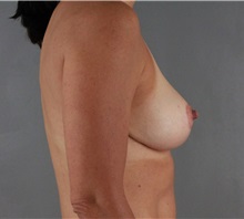 Breast Reduction After Photo by Patti Flint, MD; Scottsdale, AZ - Case 36382