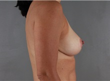 Breast Reduction After Photo by Patti Flint, MD; Scottsdale, AZ - Case 36382