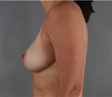 Breast Reduction After Photo by Patti Flint, MD; Scottsdale, AZ - Case 36382
