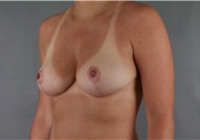 Breast Reduction After Photo by Patti Flint, MD; Scottsdale, AZ - Case 36382