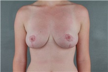 Breast Reduction After Photo by Patti Flint, MD; Scottsdale, AZ - Case 36384