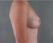 Breast Reduction After Photo by Patti Flint, MD; Scottsdale, AZ - Case 36384