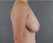 Breast Reduction Before Photo by Patti Flint, MD; Scottsdale, AZ - Case 36384