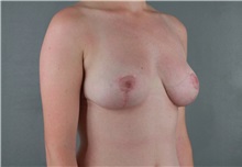 Breast Reduction After Photo by Patti Flint, MD; Scottsdale, AZ - Case 36384