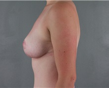 Breast Reduction After Photo by Patti Flint, MD; Scottsdale, AZ - Case 36384