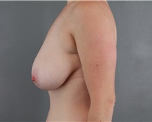 Breast Reduction Before Photo by Patti Flint, MD; Scottsdale, AZ - Case 36384